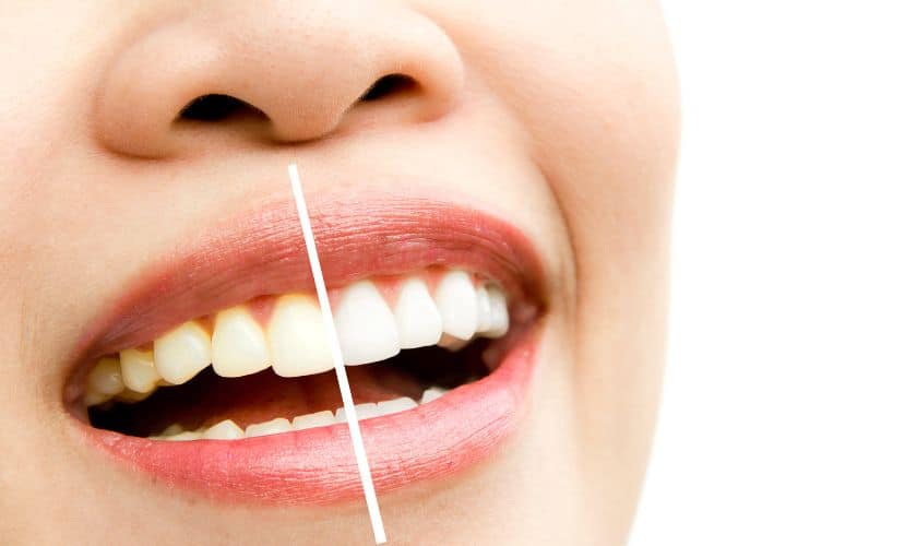 Teeth Whitening in Queen Creek, AZ