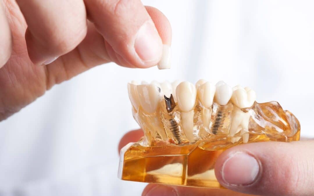 The 10 Best Alternatives to Dental Implants