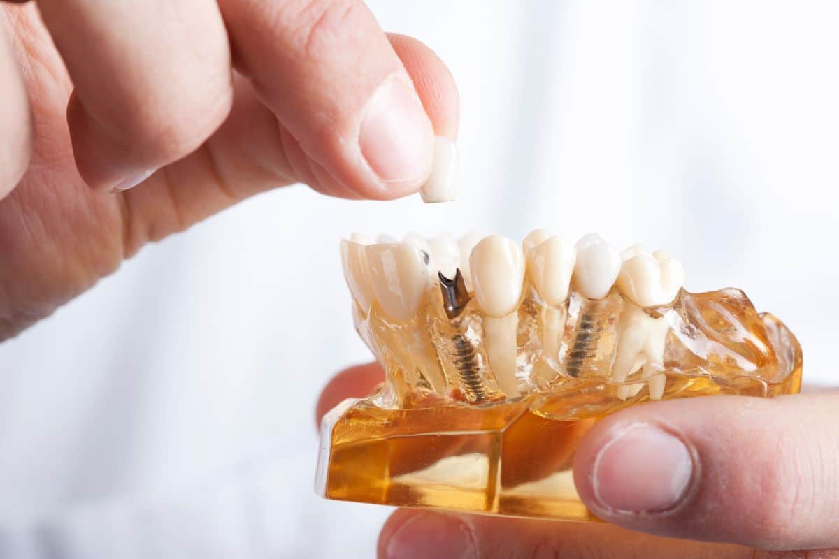 Alternatives to Dental Implants Alternatives to Dental Implants