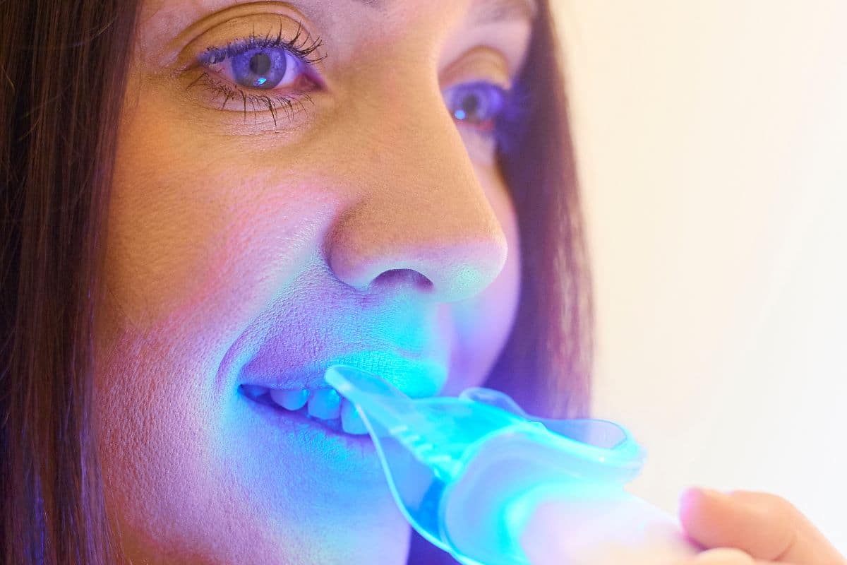 laser teeth whitening treatment