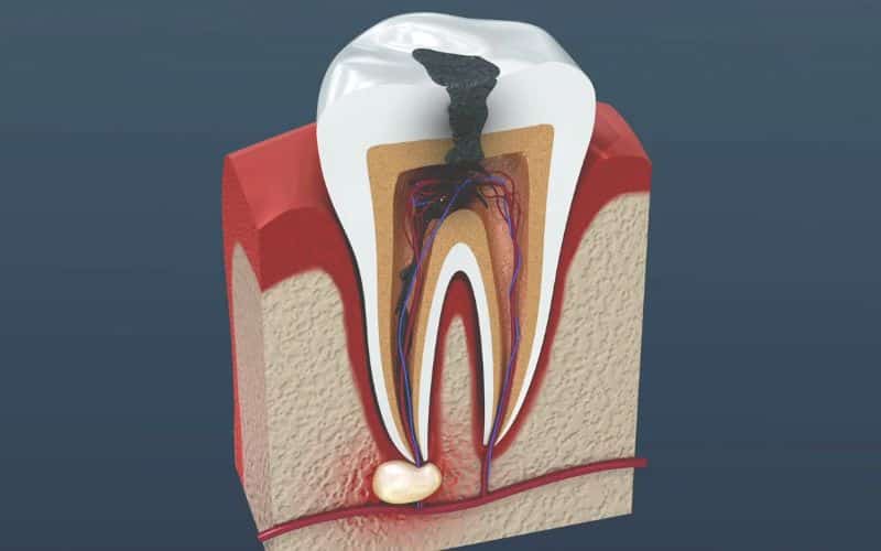 About Root Canal Treatment