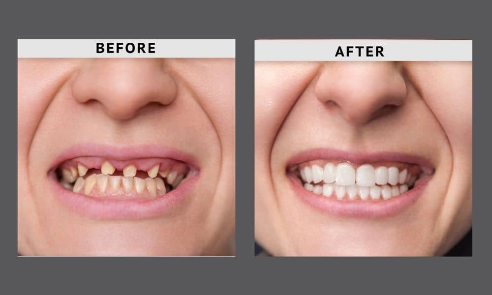All-on-X Dental Implants Before and After