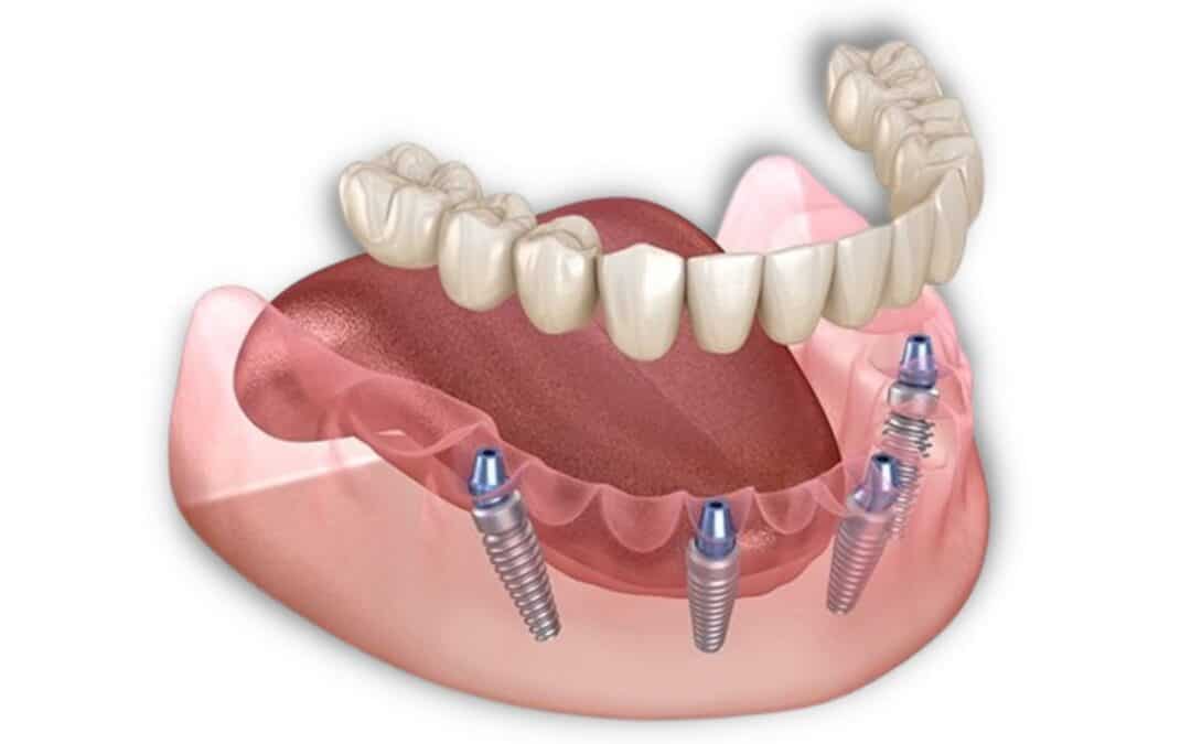 Pros and Cons of All-On-4 Dental Implants