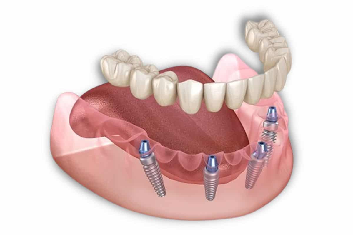 Pros and Cons of All-On-4 Dental Implants Pros and Cons of All-On-4 Dental Implants