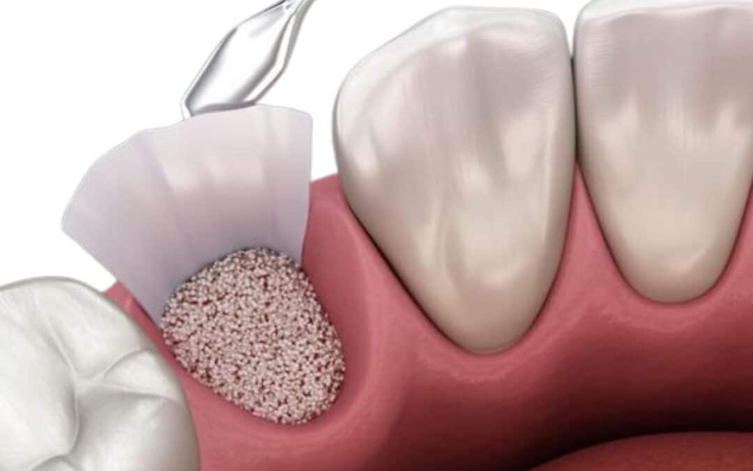 Types of Bone Grafts in Orthopedic Surgery