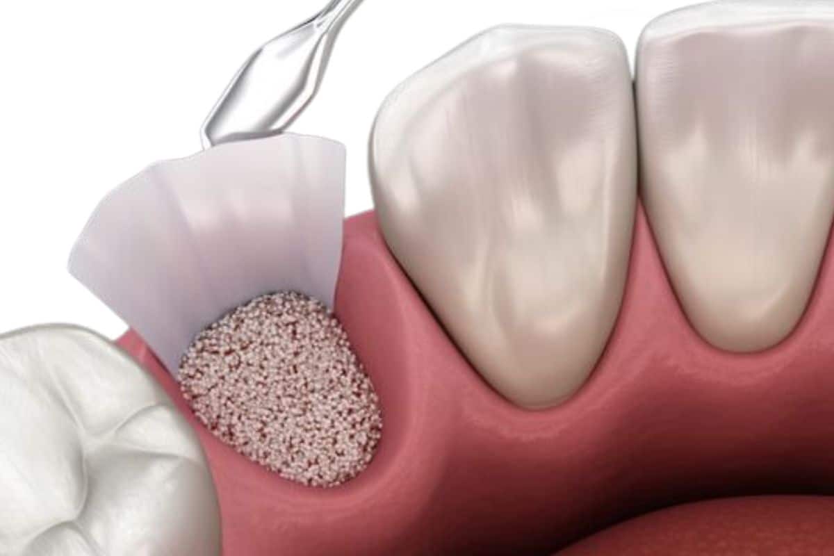 dental Bone Grafts dental Bone Grafts