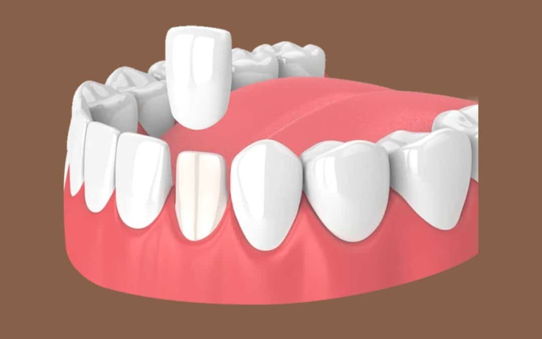5 Common Issues Veneers Can Fix: From Stains to Small Gaps