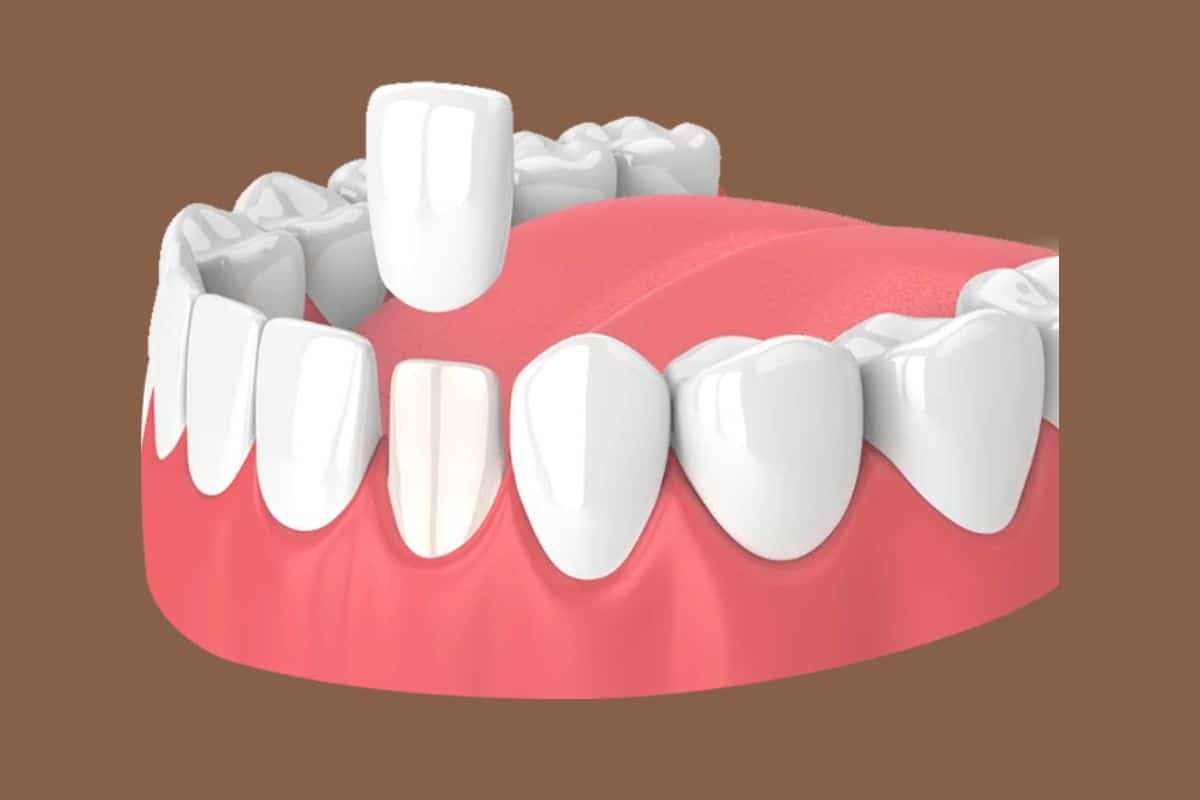 5 Common Issues Veneers Can Fix