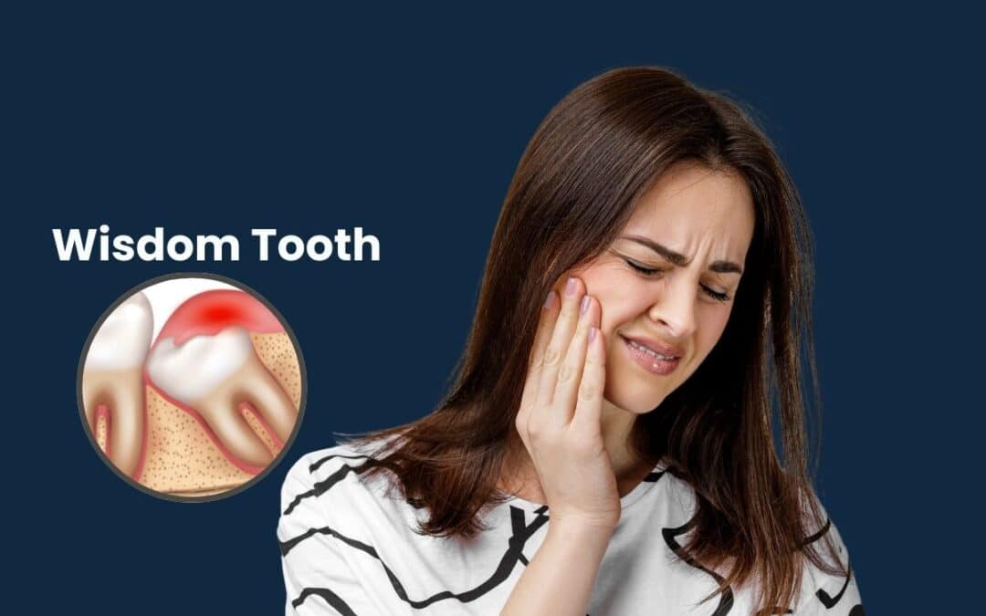 How to Brush Your Teeth After Wisdom Teeth Removal