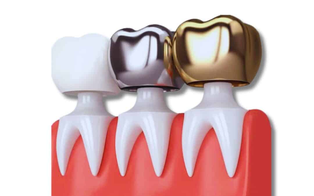 Are Dental Crowns Painful? What You Need to Know About Comfort and Recovery
