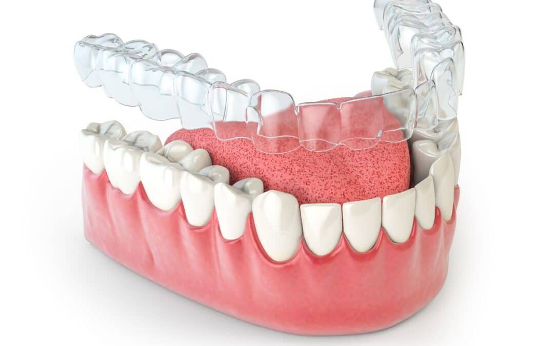 How to Avoid Gum Recession with Invisalign: Tips for a Healthy Smile