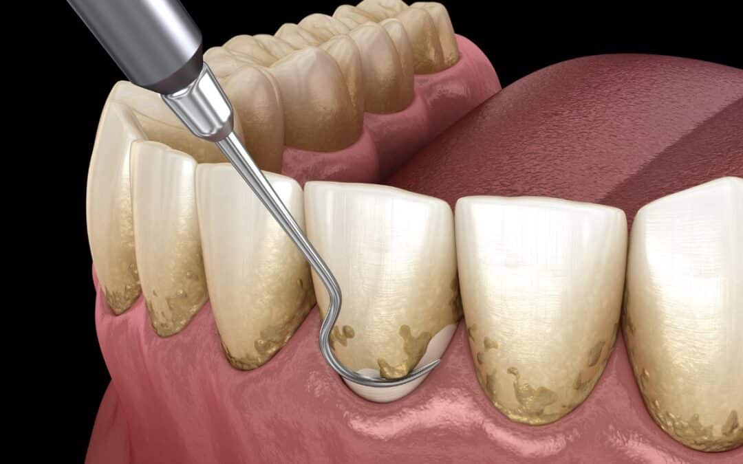 How to Get Rid of Gingivitis Fast at Home