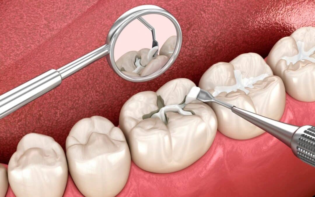 How Dental Sealants Protect Your Teeth Without The Need For Fillings