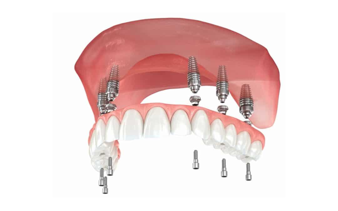 Recovery Process After All-On-4 Implant Surgery: What to Expect