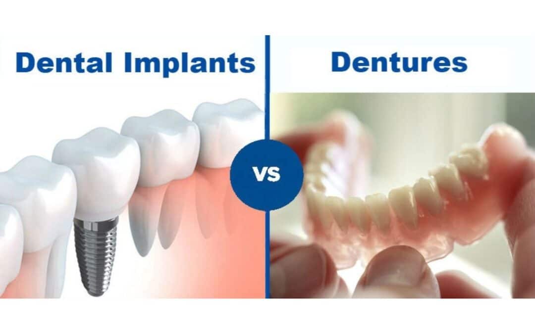 Dental Implants vs. Dentures: Which Option Is Right for You?