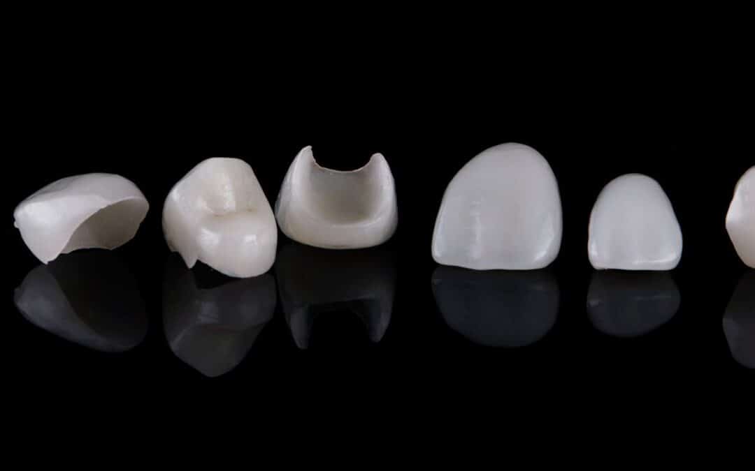 Signs It Might Be Time to Replace Your Veneers