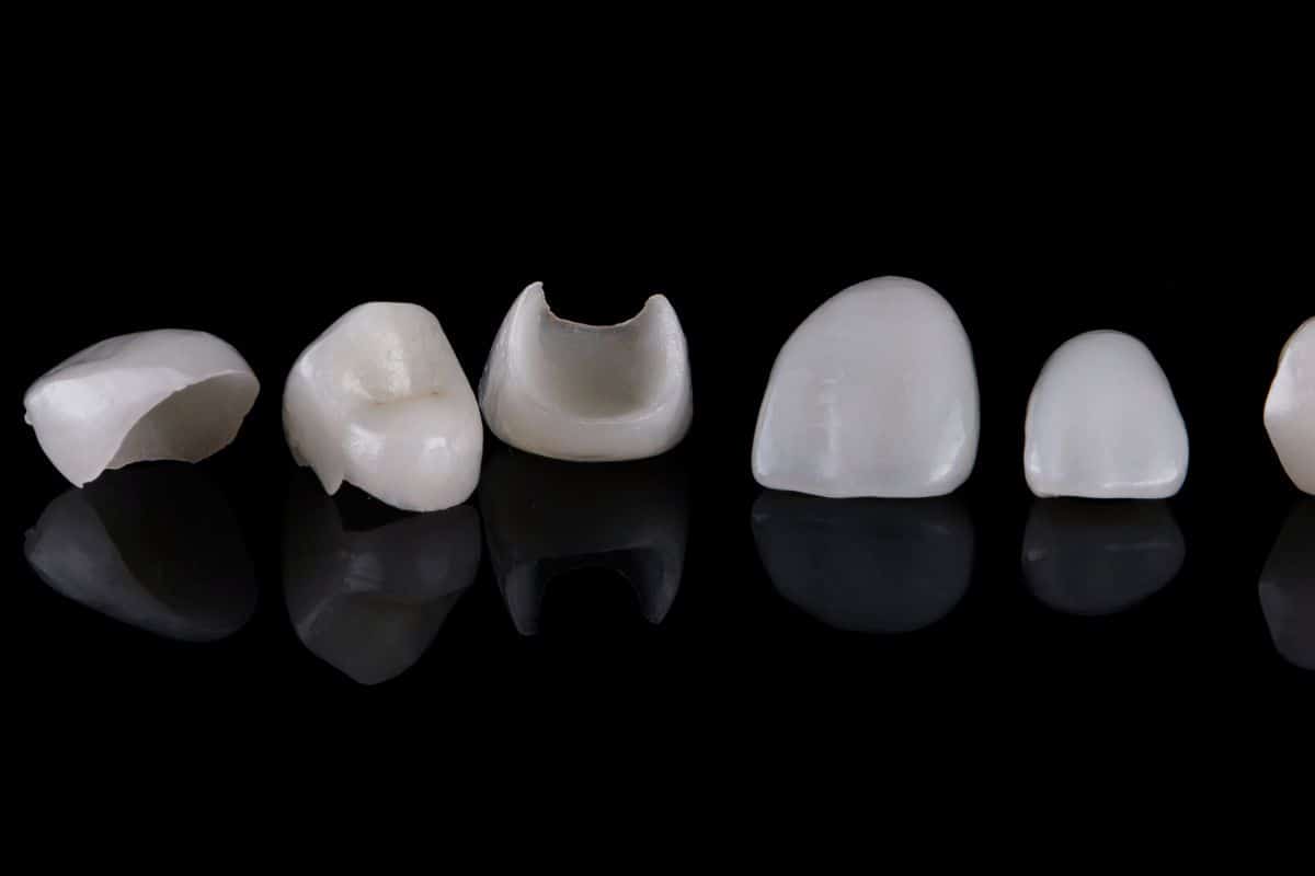 Signs It Might Be Time to Replace Your Veneers