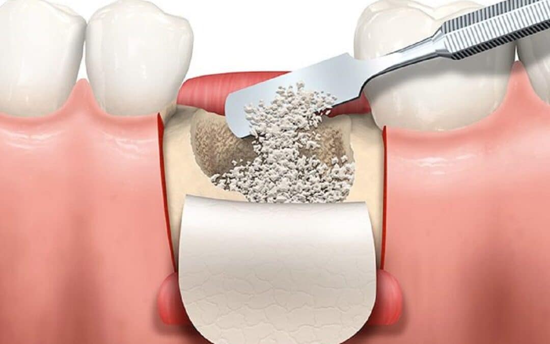 Common Myths and Misconceptions About Bone Grafting in Dentistry