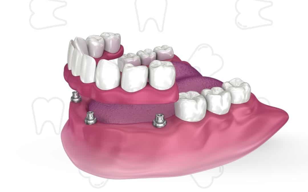 How to Care for Your All-on-4 Dental Implants After Surgery
