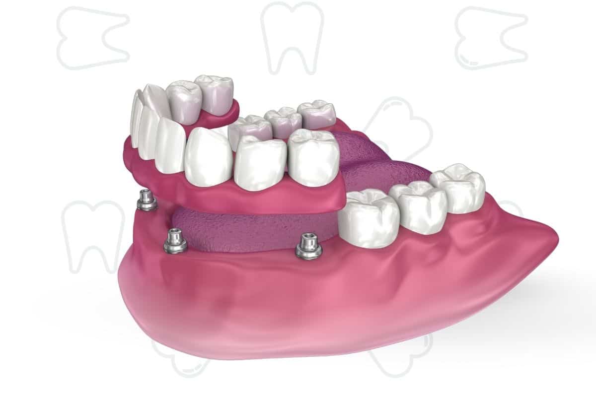 All-on-4 Dental Implants After Surger