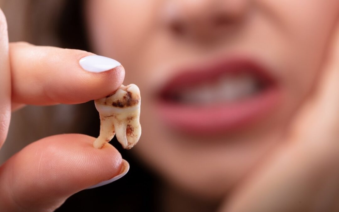 How Long Does It Take to Recover from a Non-Surgical Wisdom Tooth Extraction?