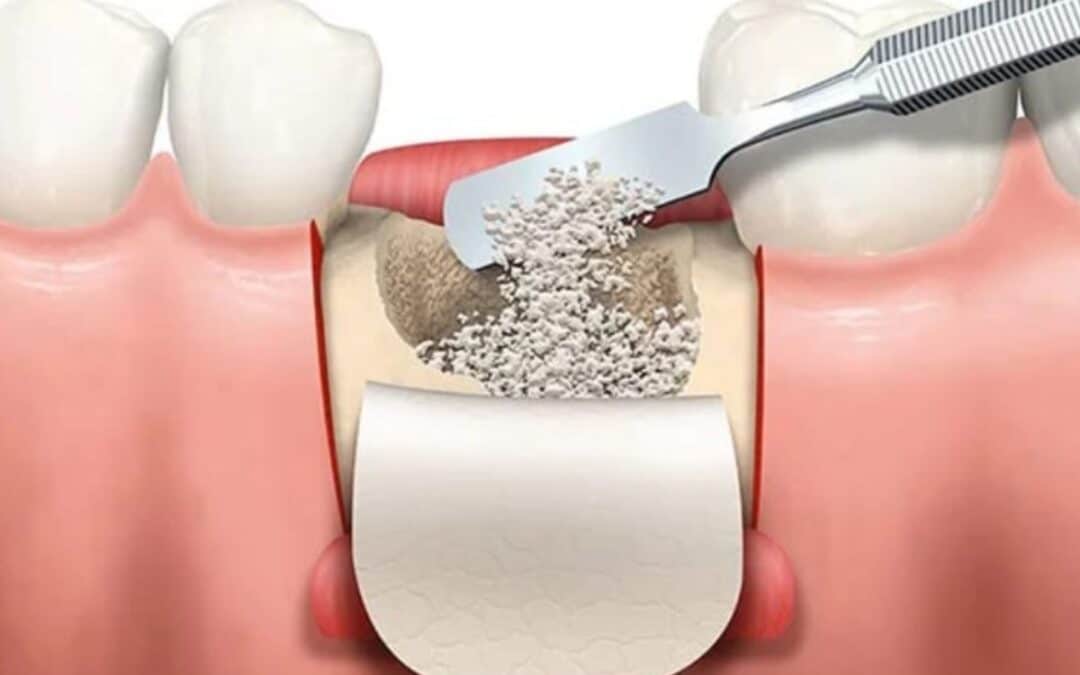Dental Bone Graft Recovery Tips: Do’s and Don’ts for Optimal Healing