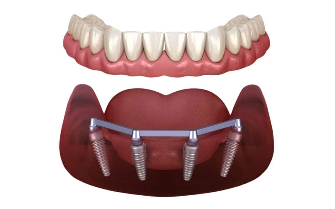 Recovery After All-on-4 Surgery: What You Need to Know