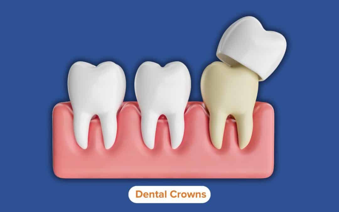 How Dental Crowns Protect and Strengthen Damaged Teeth