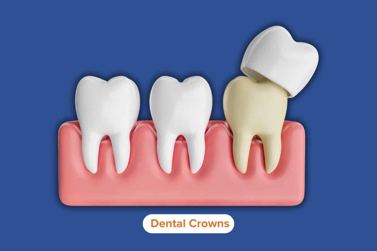 Dental Crowns Protect and Strengthen Damaged Teeth