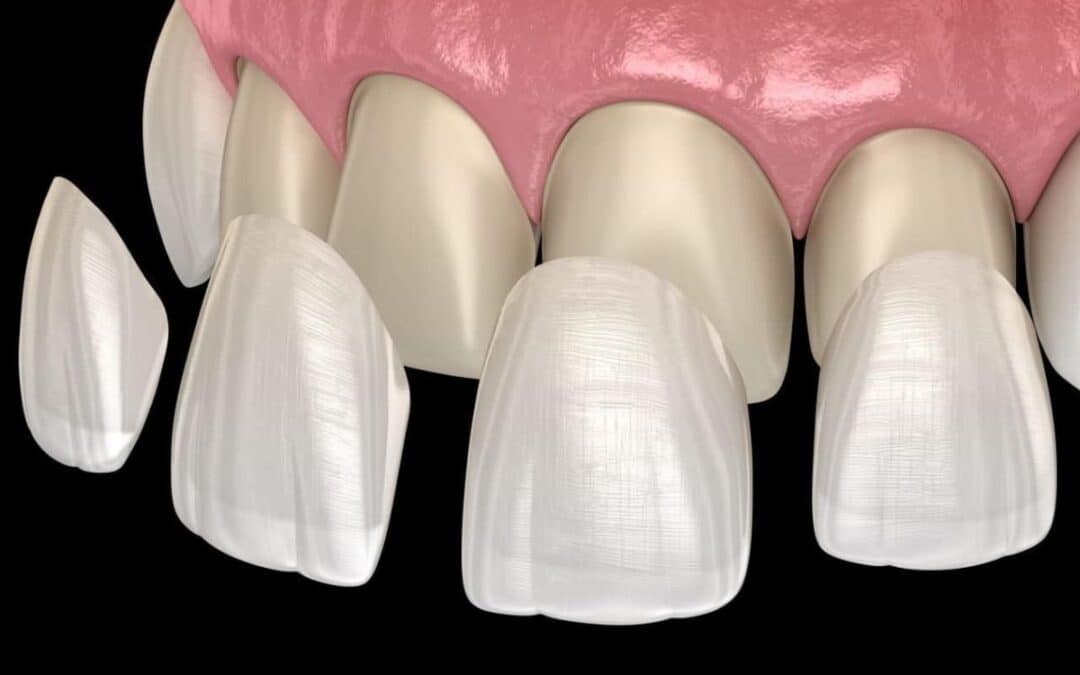 Fixing Chipped or Cracked Teeth with Porcelain Veneers