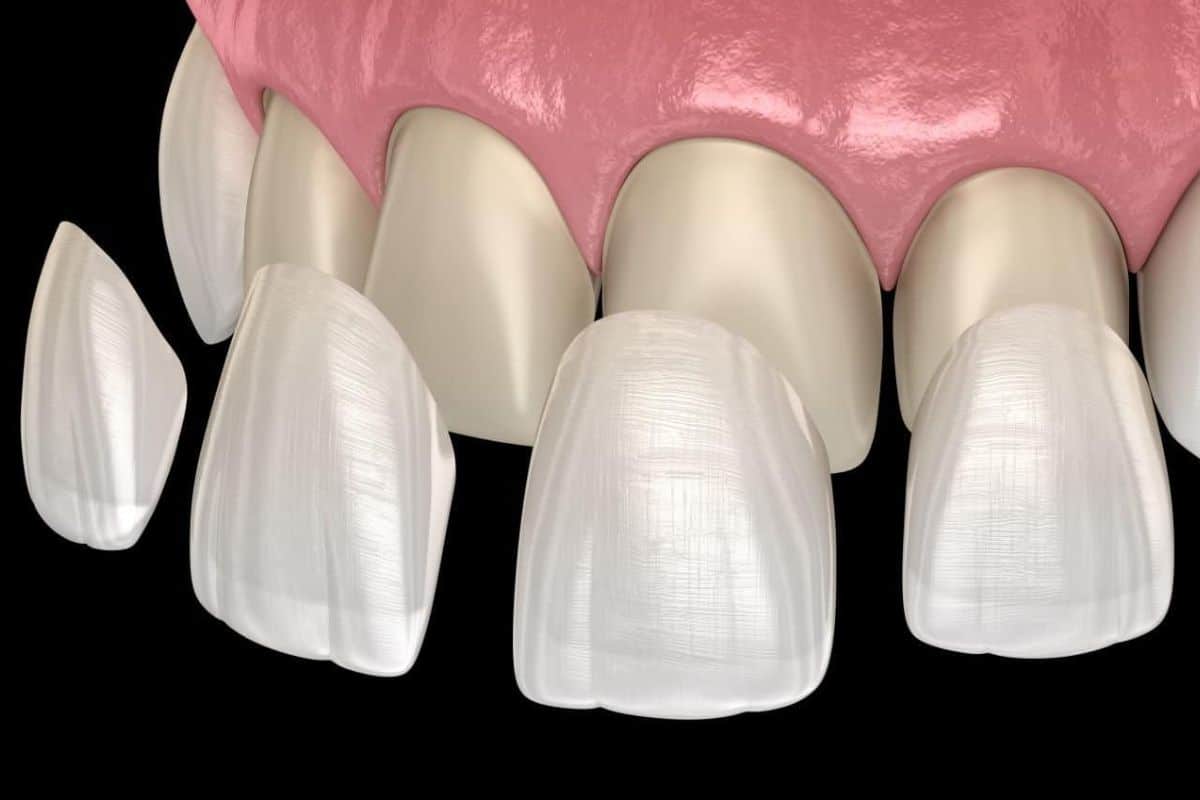 Fixing Chipped or Cracked Teeth with Porcelain Veneers