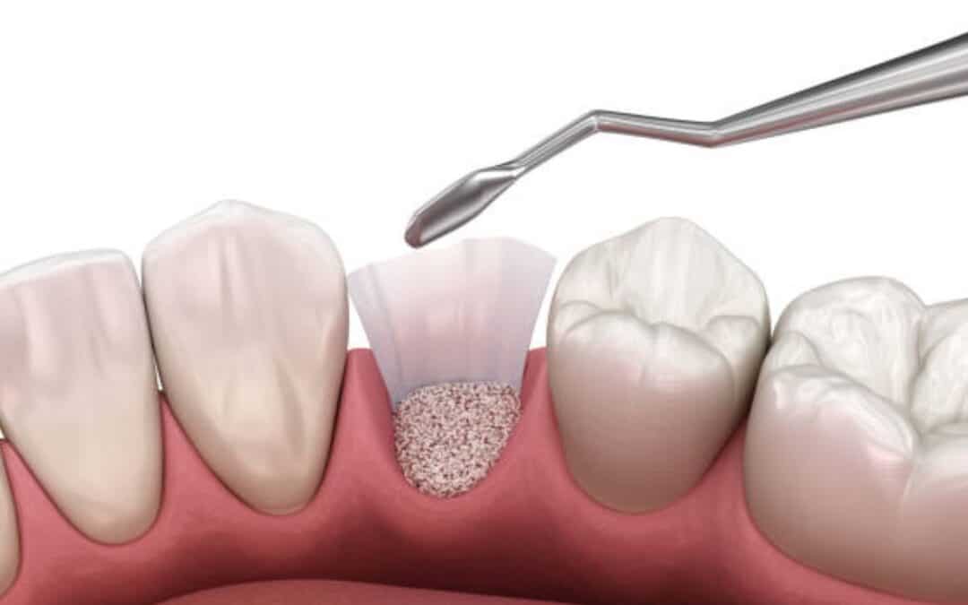 How Bone Grafting Repairs Jaw Damage from Gum Disease