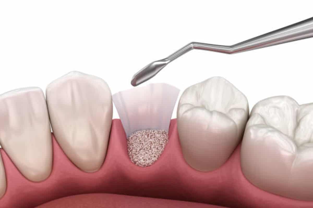 How Bone Grafting Repairs Jaw Damage from Gum Disease