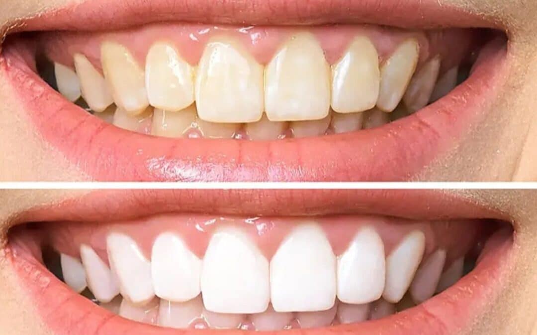How to Whiten Your Teeth Naturally: 6 Home Remedies