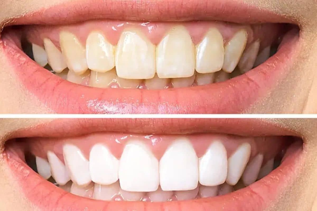 How to whiten your teeth naturally