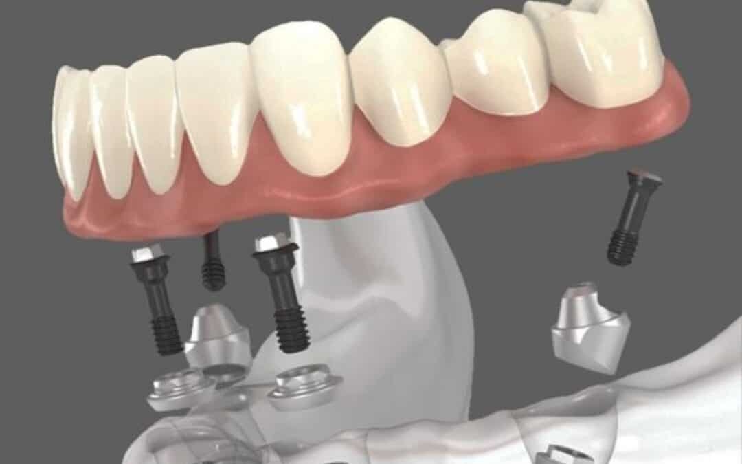 Recovery Timeline for All-on-4 Dental Implants: Week by Week