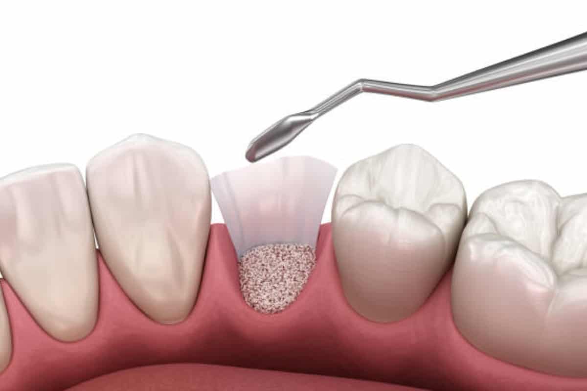 Why Bone Grafting Is Needed Before Dental Implants Bone Grafting Is Needed Before Dental Implants