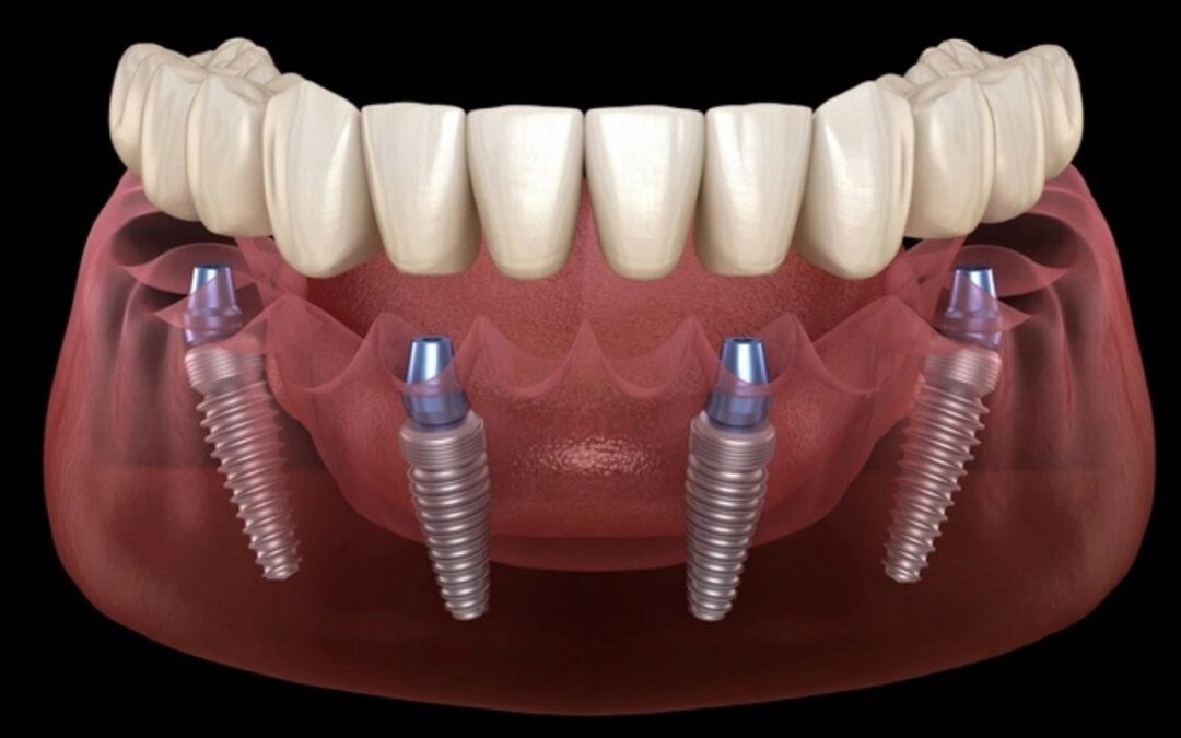 How Long After All-on-4 Dental Implants Can I Eat Normally?