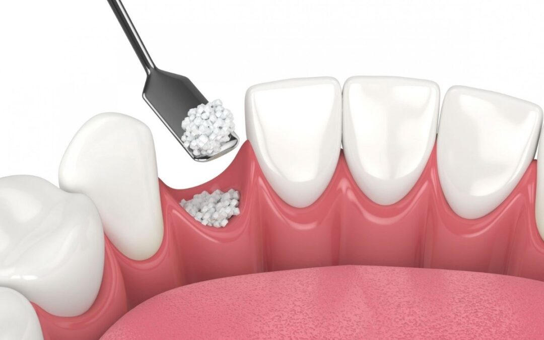 How Bone Grafting Restores Your Smile After Tooth Loss or Gum Disease