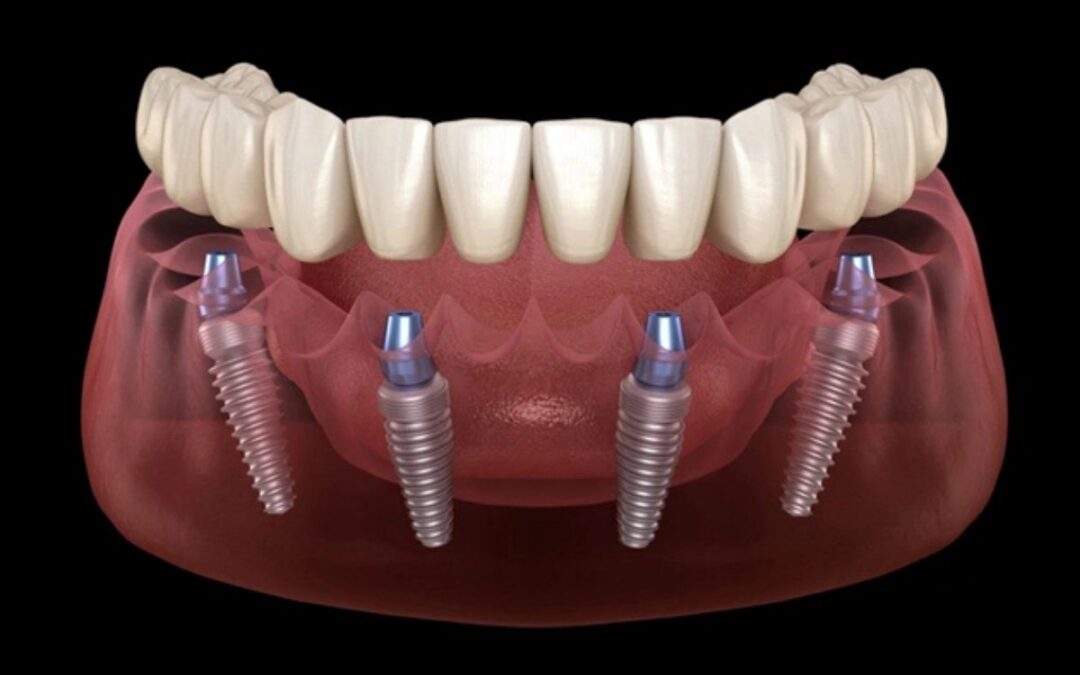 Top Benefits of All-on-4 Implants: Faster, Stronger, and More Natural