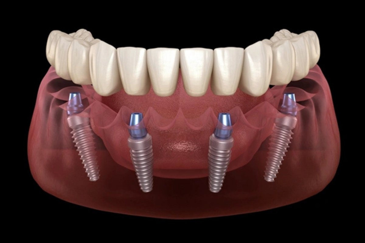 Top Benefits of All-on-4 Implants Faster, Stronger, and More Natural Top Benefits of All-on-4 Implants: Faster, Stronger, and More Natural
