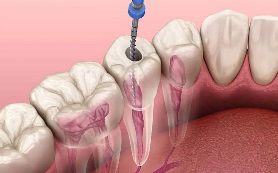 Understanding Root Canal Therapy: How It Saves Infected Teeth