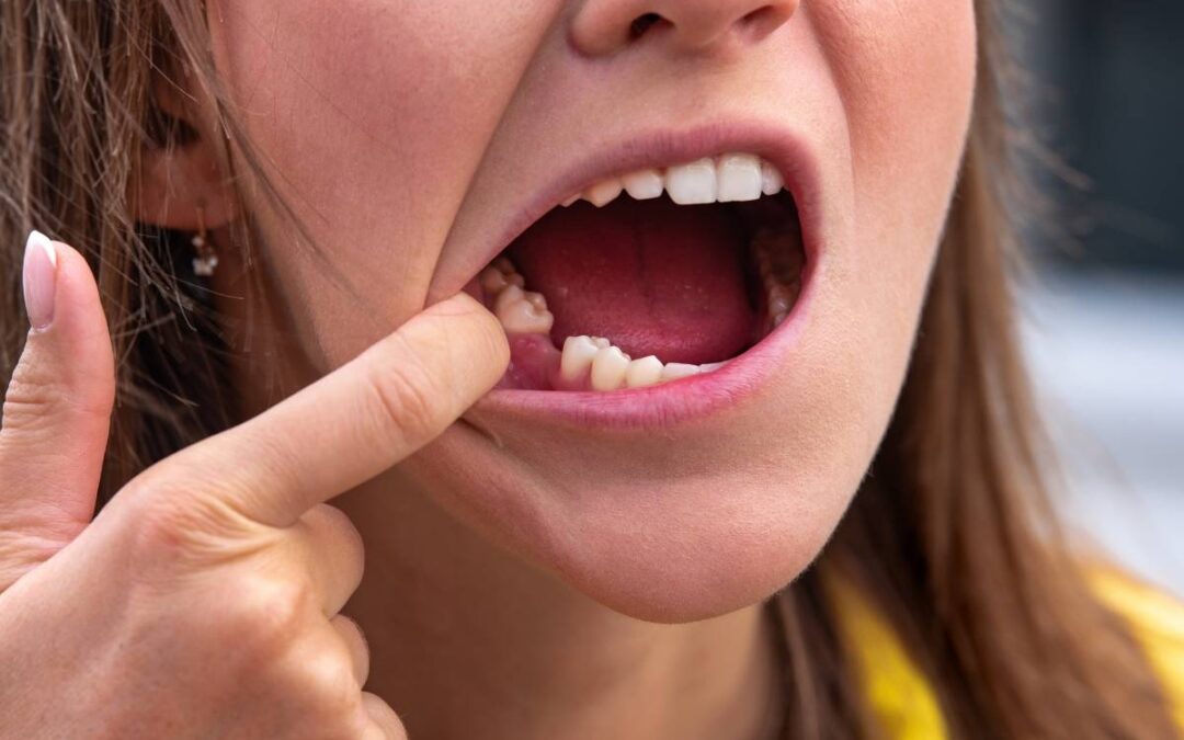 What Are the Warning Signs of Dry Socket? A Dentist Explains the Symptoms You Shouldn’t Ignore