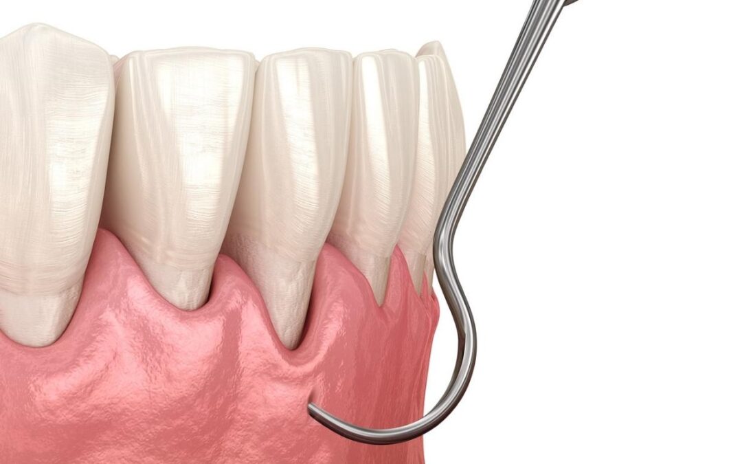 Recovery Tips After Pinhole Gum Rejuvenation: How to Heal Comfortably