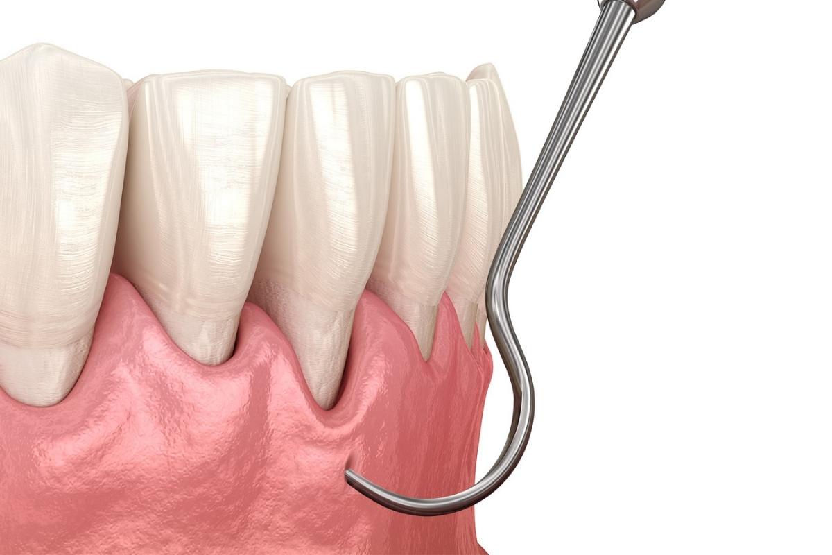 Queen Creek Gum Recession Recovery Tips Pinhole Gum Rejuvenation Guide Pinhole Gum Rejuvenation Guide