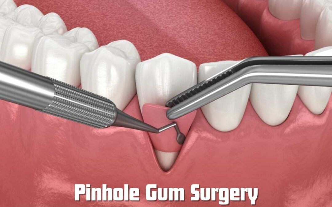 Prevent Gum Recession: How the Pinhole Technique Protects Your Smile