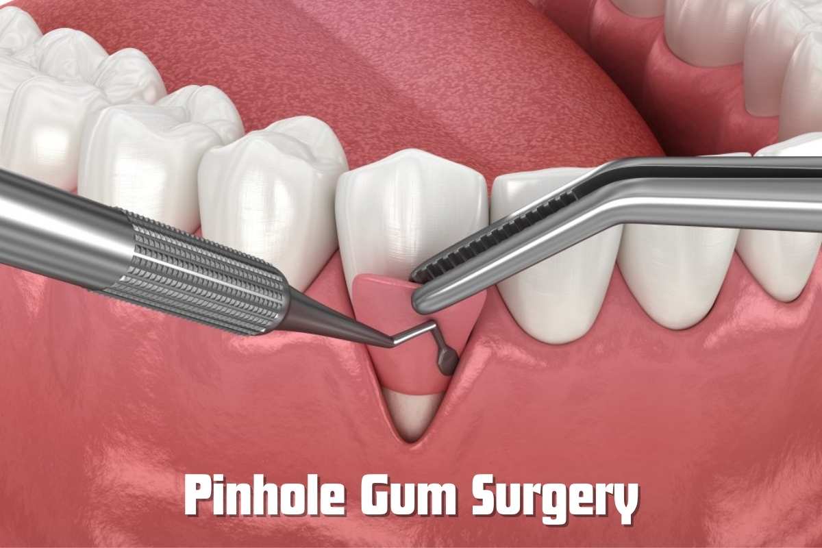 Prevent Gum Recession with the Pinhole Technique | Queen Creek, AZ