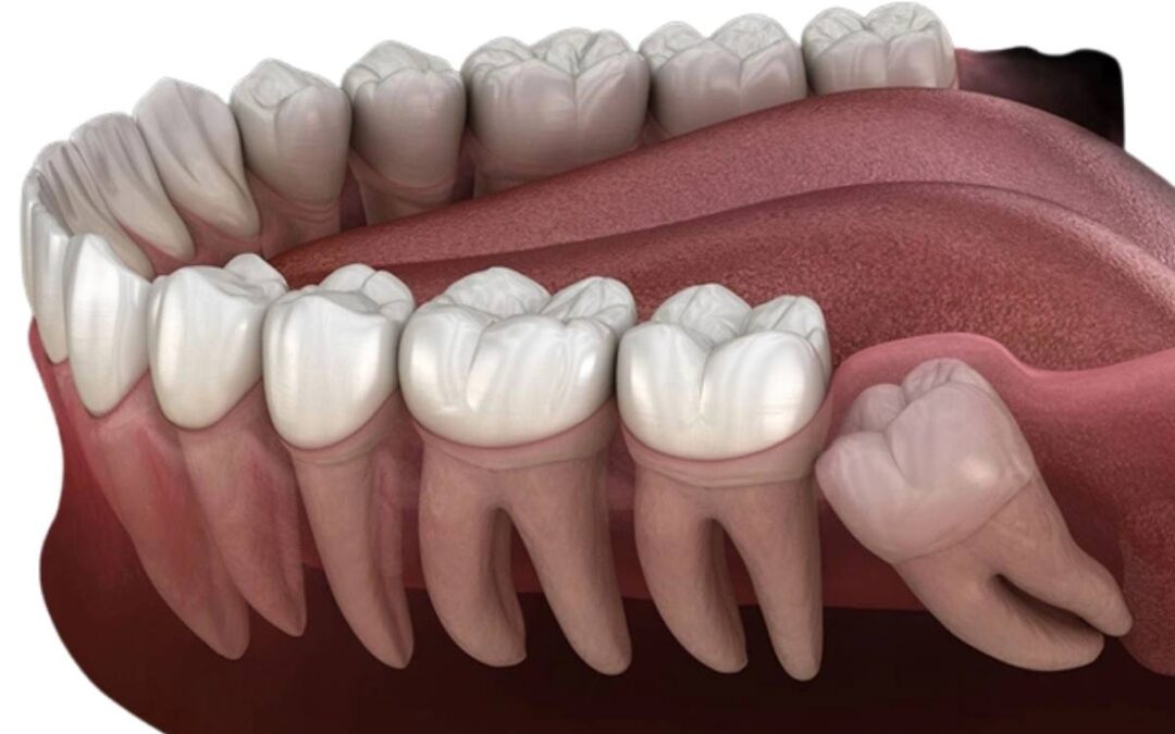 Faster Recovery After Wisdom Teeth Removal: Expert Advice Every Patient Should Follow