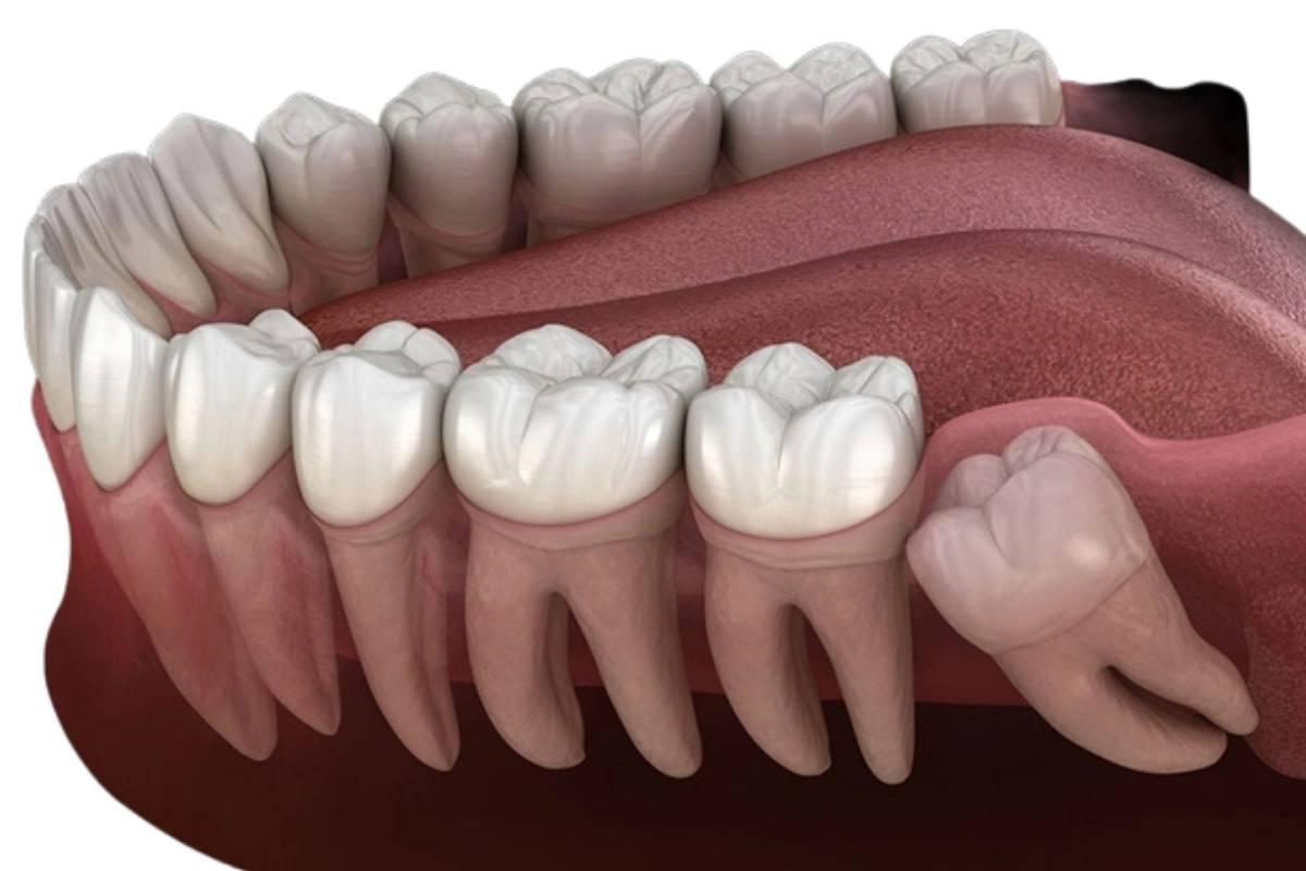 Expert Advice for Faster Wisdom Teeth Recovery Dentist explaining faster recovery tips after wisdom teeth removal