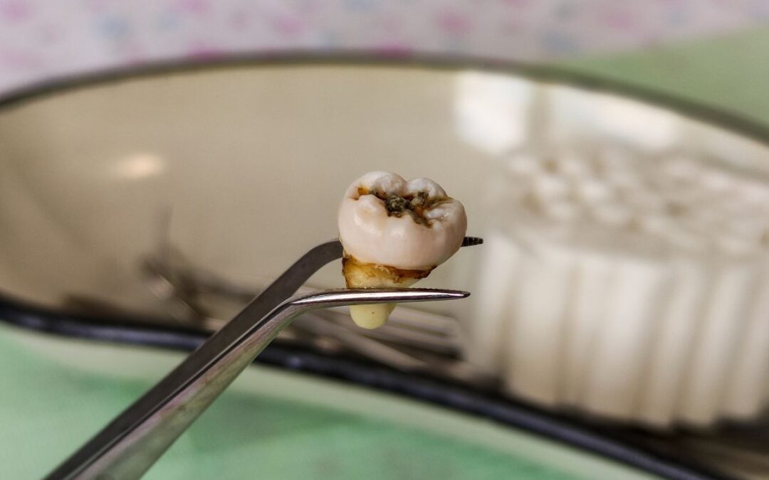 Understanding Tooth Extraction Recovery: How Long Does Healing Really Take?